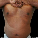 High Def Liposuction Male Before & After Patient #2731