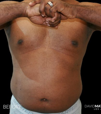 High Def Liposuction Male Before & After Patient #2731