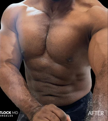 High Def Liposuction Male Before & After Patient #2731