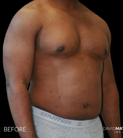 High Def Liposuction Male Before & After Patient #2731