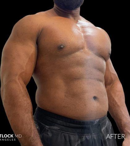 High Def Liposuction Male Before & After Patient #2731
