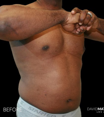 High Def Liposuction Male Before & After Patient #2731