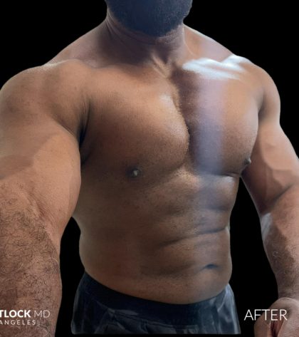 High Def Liposuction Male Before & After Patient #2731