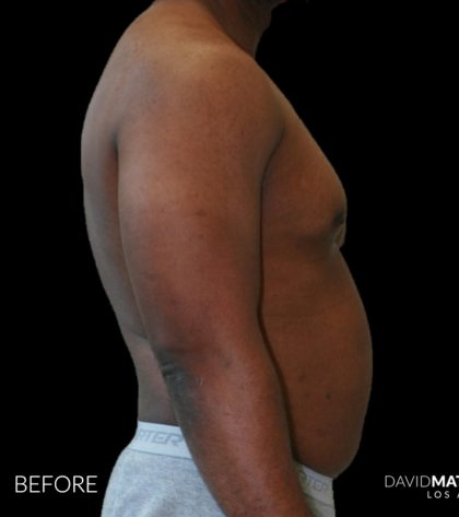 High Def Liposuction Male Before & After Patient #2731