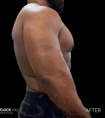 High Def Liposuction Male Before & After Patient #2731