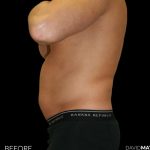 High Def Liposuction Male Before & After Patient #2732
