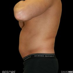 High Def Liposuction Male Before & After Patient #2732
