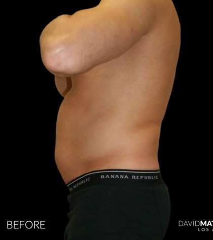 High Def Liposuction Male Before & After Patient #2732