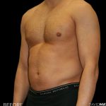 High Def Liposuction Male Before & After Patient #2732