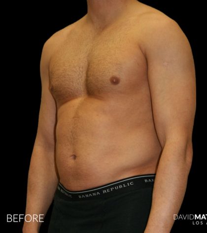 High Def Liposuction Male Before & After Patient #2732