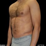 High Def Liposuction Male Before & After Patient #2732