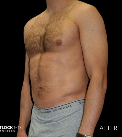 High Def Liposuction Male Before & After Patient #2732