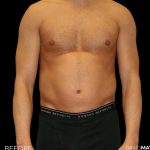 High Def Liposuction Male Before & After Patient #2732