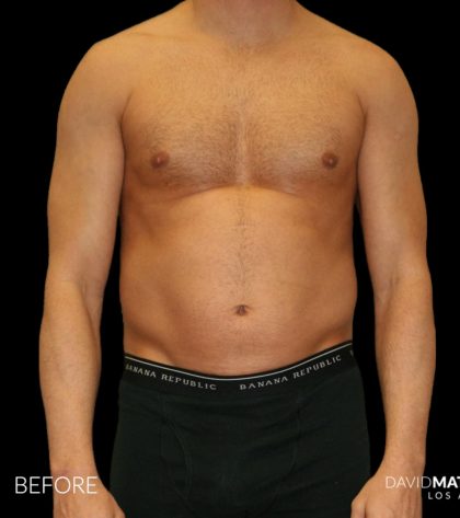 High Def Liposuction Male Before & After Patient #2732