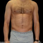 High Def Liposuction Male Before & After Patient #2732