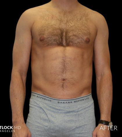 High Def Liposuction Male Before & After Patient #2732