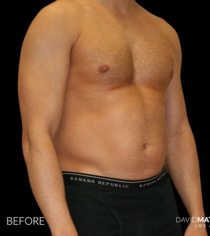 High Def Liposuction Male Before & After Patient #2732
