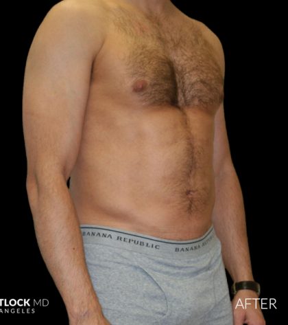High Def Liposuction Male Before & After Patient #2732