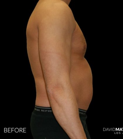 High Def Liposuction Male Before & After Patient #2732
