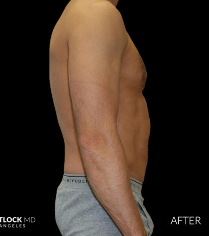 High Def Liposuction Male Before & After Patient #2732