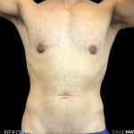High Def Liposuction Male Before & After Patient #2733