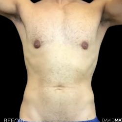 High Def Liposuction Male Before & After Patient #2733