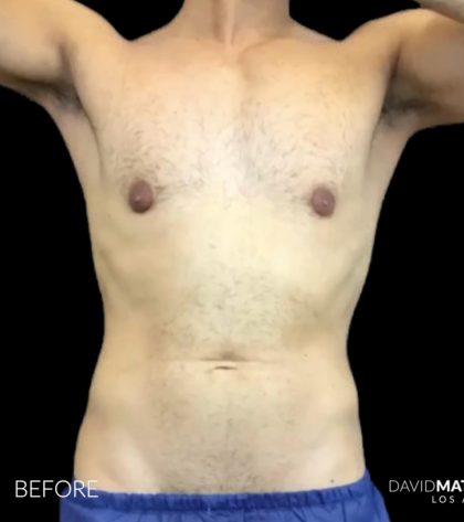 High Def Liposuction Male Before & After Patient #2733