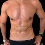 High Def Liposuction Male Before & After Patient #2733