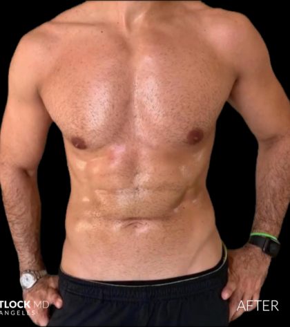 High Def Liposuction Male Before & After Patient #2733
