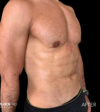 High Def Liposuction Male Before & After Patient #2733
