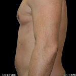 High Def Liposuction Male Before & After Patient #2734
