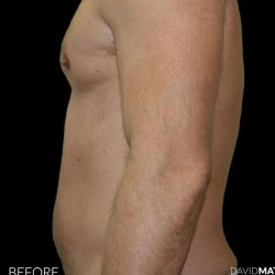 High Def Liposuction Male Before & After Patient #2734