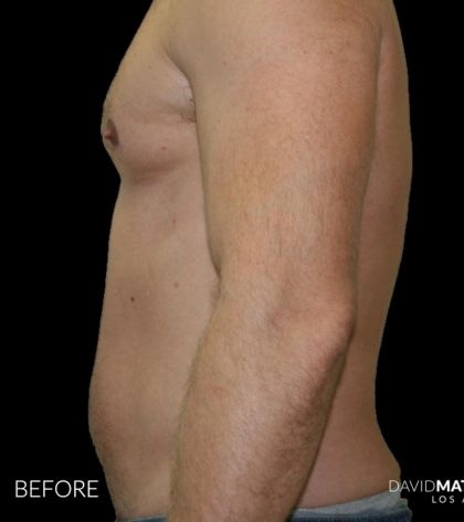 High Def Liposuction Male Before & After Patient #2734