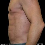 High Def Liposuction Male Before & After Patient #2734