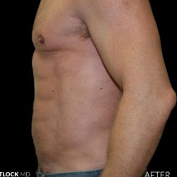 High Def Liposuction Male Before & After Patient #2734