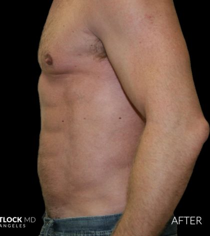 High Def Liposuction Male Before & After Patient #2734