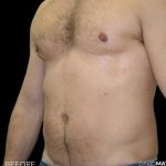High Def Liposuction Male Before & After Patient #2734