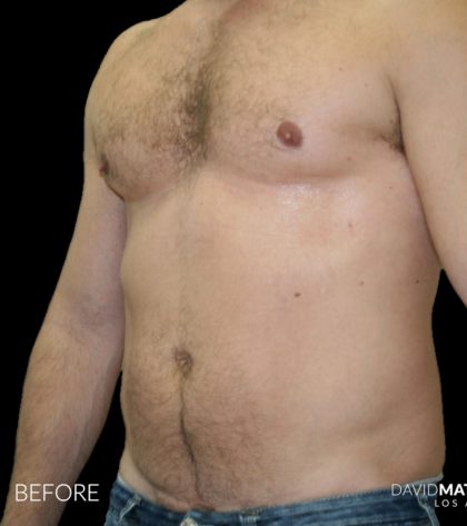 High Def Liposuction Male Before & After Patient #2734