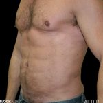 High Def Liposuction Male Before & After Patient #2734