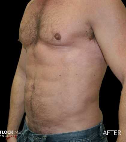 High Def Liposuction Male Before & After Patient #2734