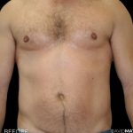 High Def Liposuction Male Before & After Patient #2734
