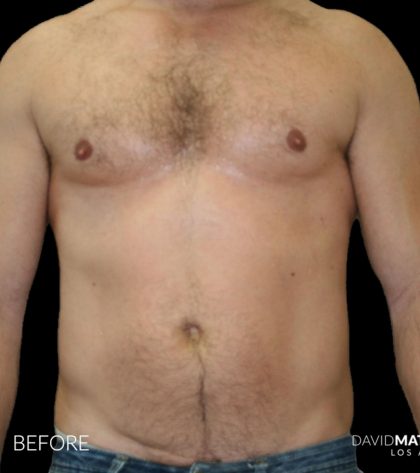 High Def Liposuction Male Before & After Patient #2734