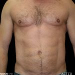 High Def Liposuction Male Before & After Patient #2734