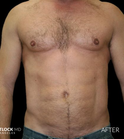 High Def Liposuction Male Before & After Patient #2734