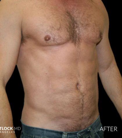 High Def Liposuction Male Before & After Patient #2734