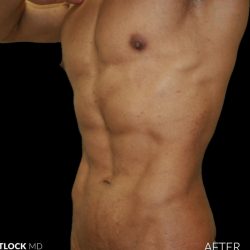 High Def Liposuction Male Before & After Patient #2735