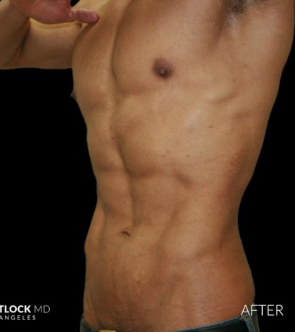High Def Liposuction Male Before & After Patient #2735