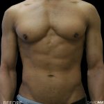 High Def Liposuction Male Before & After Patient #2735