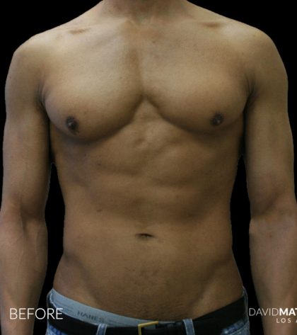 High Def Liposuction Male Before & After Patient #2735