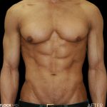 High Def Liposuction Male Before & After Patient #2735